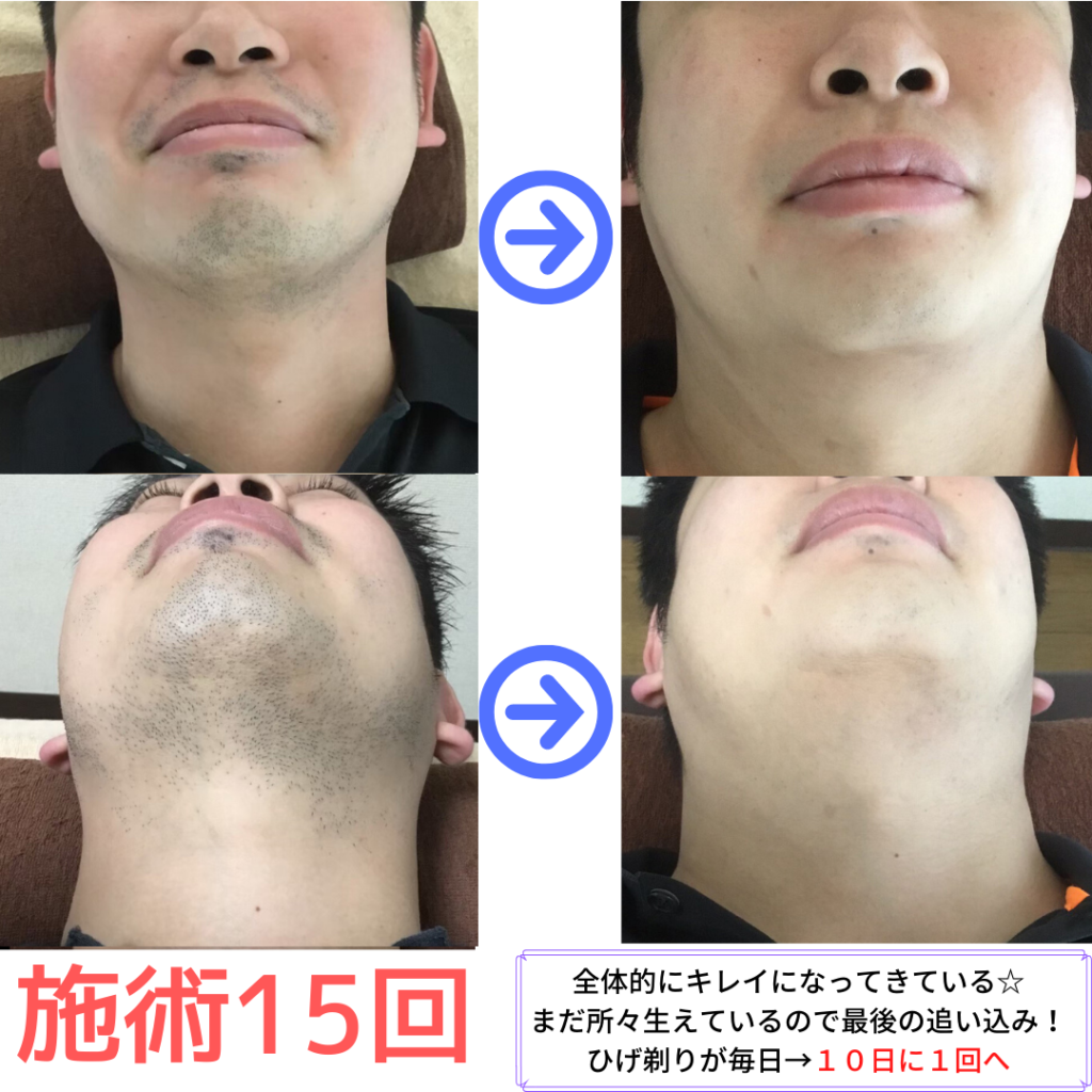 スタッフ　ヒゲ脱毛　１５回